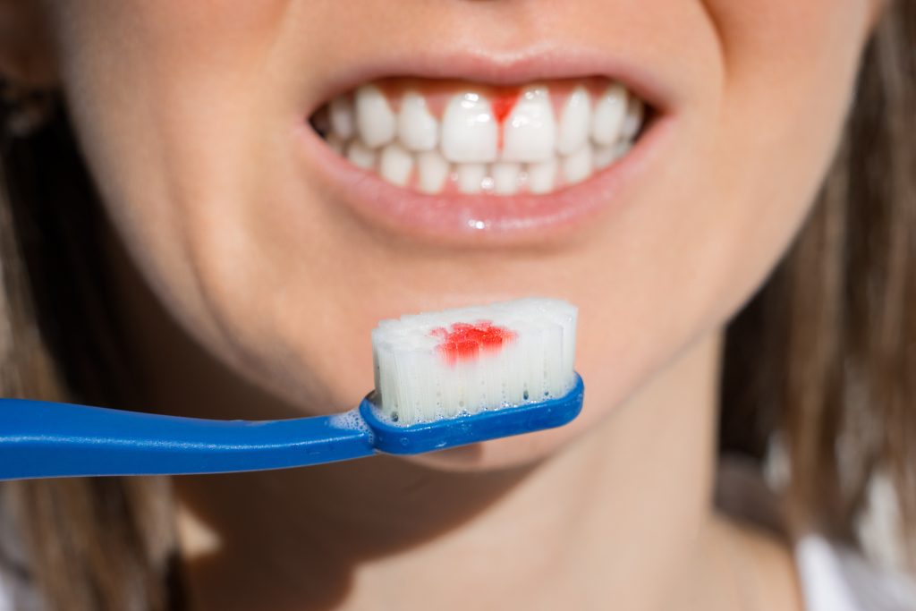 Woman Mouth With Bleeding Gums During Teeth Brushing. Avitaminosis, Gingivitis