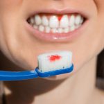 Woman Mouth With Bleeding Gums During Teeth Brushing. Avitaminosis, Gingivitis