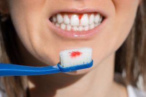 Woman Mouth With Bleeding Gums During Teeth Brushing. Avitaminosis, Gingivitis